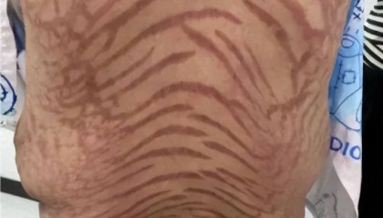 触目惊心,女子涂了10年“网红药”,全身长满“蛇纹”,彻底傻眼