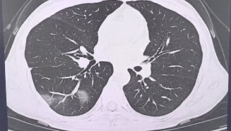 查出流感没在意,女子硬扛三天后肺都“白”了……