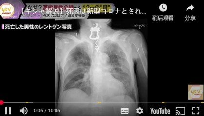 日本82岁老人喉咙痛被确诊新冠病死, X光发现是钥匙卡喉咙