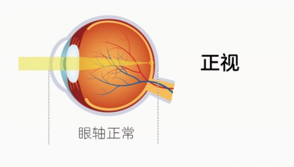 什么是远视储备?它和预防近视有什么关系?