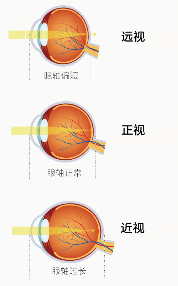 什么是远视储备？它和预防近视有什么关系？